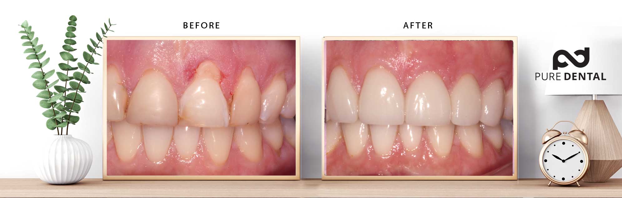 How Pure Dental fixes receding gums without surgery